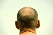 Male pattern baldness