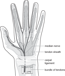 Carpal Tunnel Syndrome