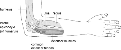 Tennis elbow